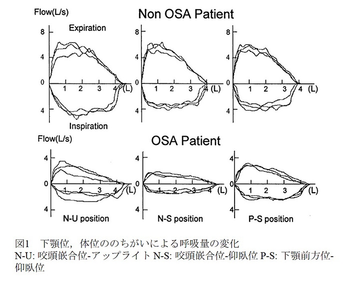 図2：磁性アタッチメント義歯の基本構造