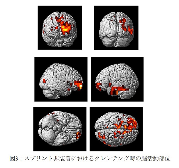 図3：スプリント非装着におけるクレンチング時の脳活動部位